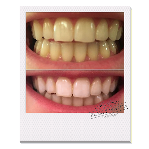 teeth whitening products reviews